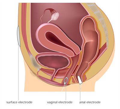 Electrotherapy - Incontinence treatment Electrotherapy - Incontinence treatment